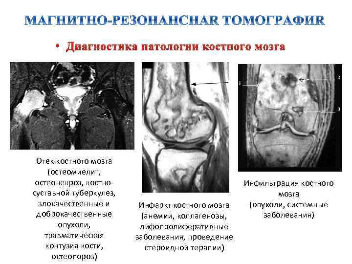  • Диагностика патологии костного мозга Отек костного мозга (остеомиелит, остеонекроз, костносуставной туберкулез, злокачественные