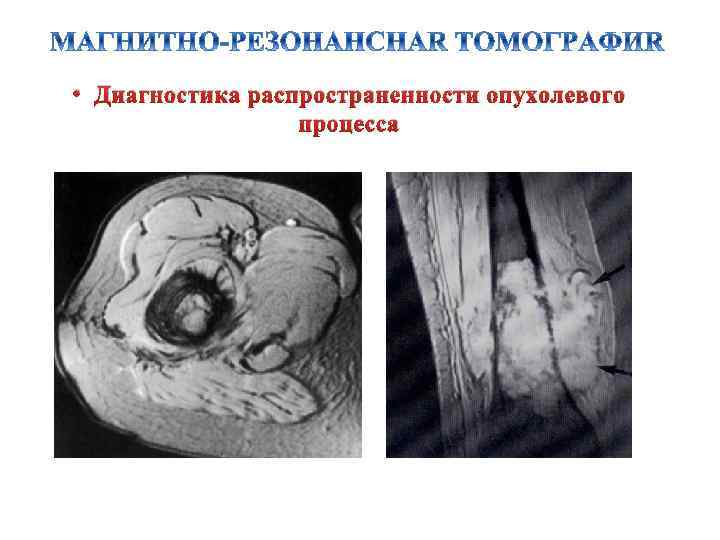  • Диагностика распространенности опухолевого процесса 