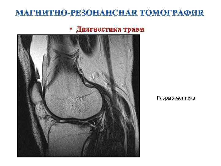  • Диагностика травм Разрыв мениска 