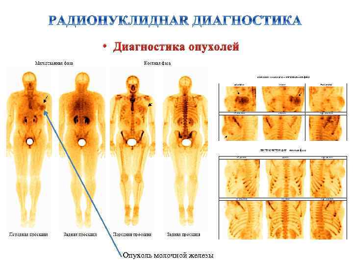  • Диагностика опухолей Опухоль молочной железы 