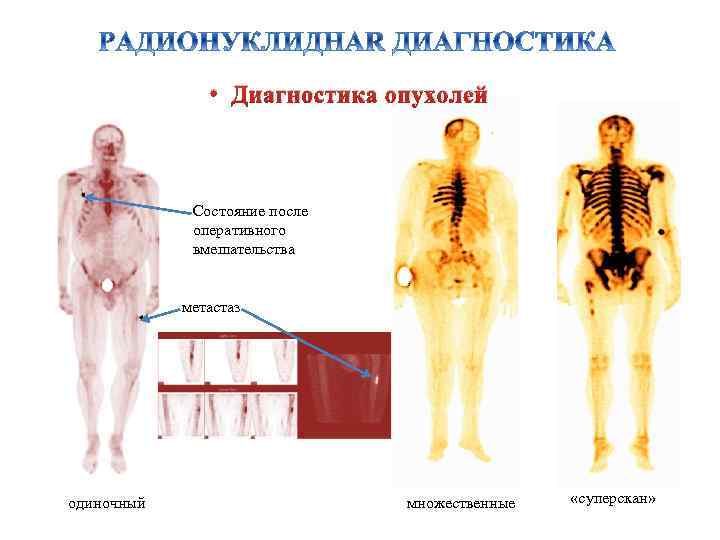  • Диагностика опухолей Состояние после оперативного вмешательства метастаз одиночный множественные «суперскан» 