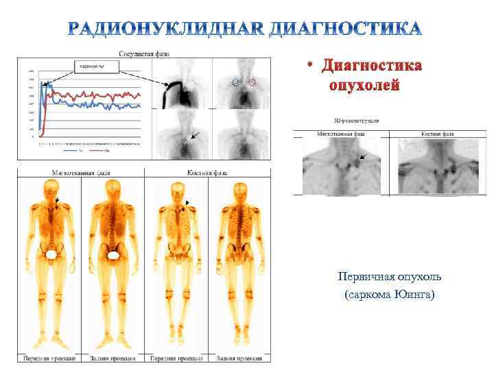  • Диагностика опухолей Первичная опухоль (саркома Юинга) 