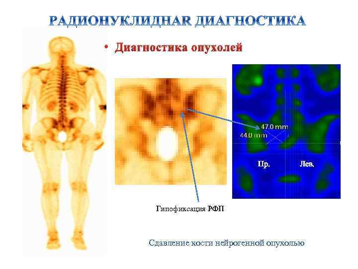  • Диагностика опухолей Пр. Лев. Гипофиксация РФП Сдавление кости нейрогенной опухолью 