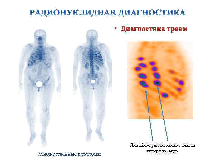  • Диагностика травм Множественные переломы Линейное расположение очагов гиперфиксации 