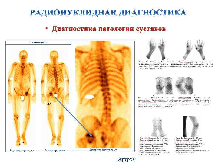  • Диагностика патологии суставов Артроз 