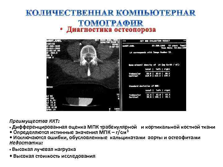  • Диагностика остеопороза Преимущества ККТ: • Дифференцированная оценка МПК трабекулярной и кортикальной костной