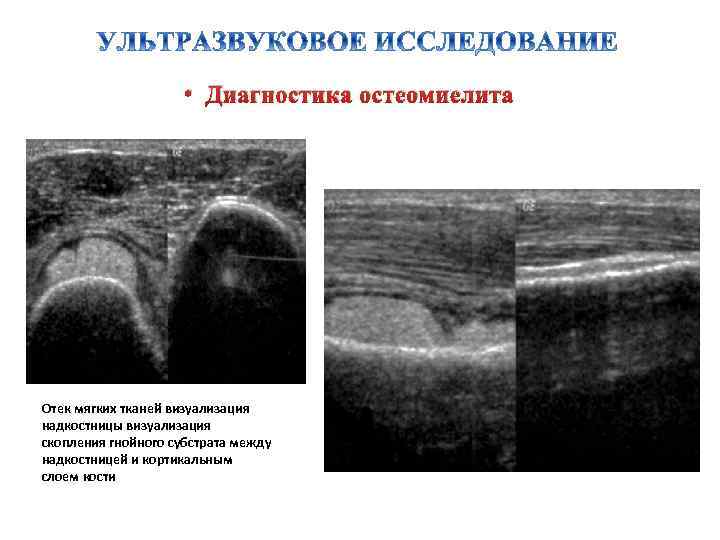 Саркома мягких тканей на узи фото признаки и лечение