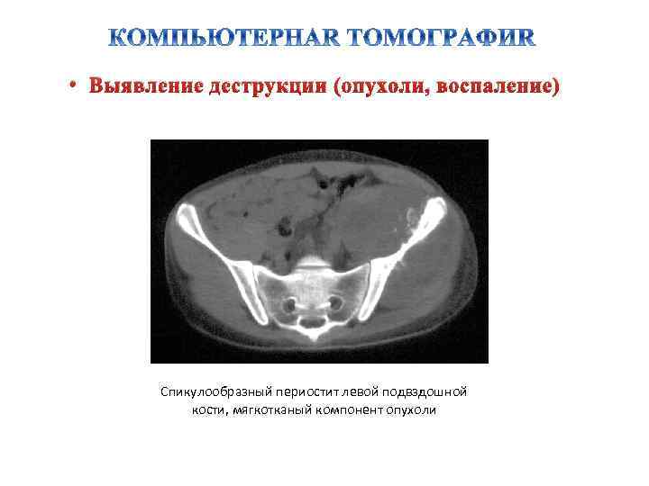  • Выявление деструкции (опухоли, воспаление) Спикулообразный периостит левой подвздошной кости, мягкотканый компонент опухоли