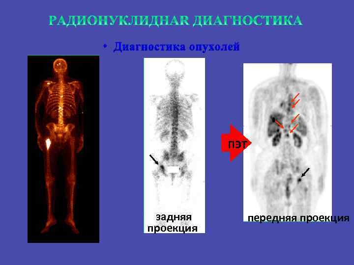  • Диагностика опухолей ПЭТ задняя проекция передняя проекция 