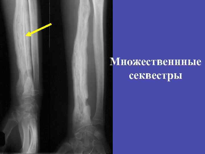 Множественнные секвестры 