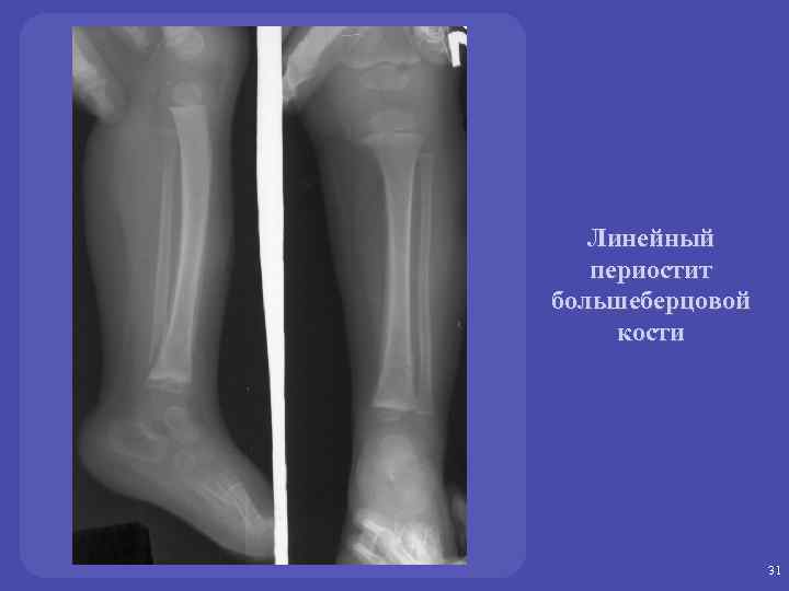 Линейный периостит большеберцовой кости 31 