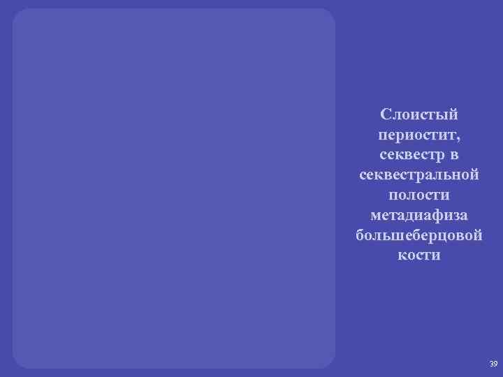 Слоистый периостит, секвестр в секвестральной полости метадиафиза большеберцовой кости 39 