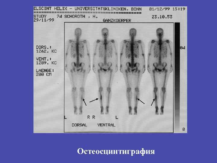 Остеосцинтиграфия 