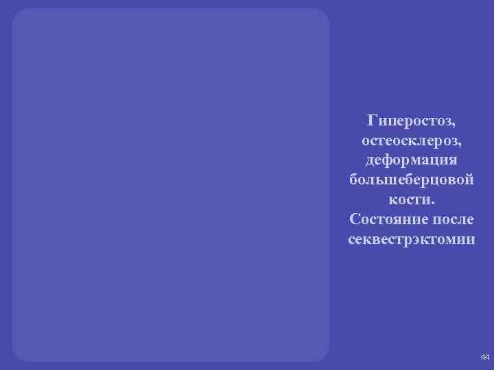 Гиперостоз, остеосклероз, деформация большеберцовой кости. Состояние после секвестрэктомии 44 