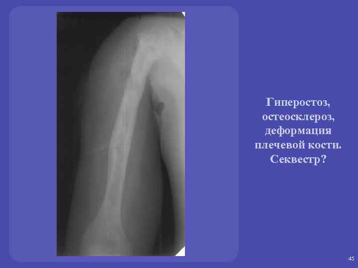 Гиперостоз, остеосклероз, деформация плечевой кости. Секвестр? 45 