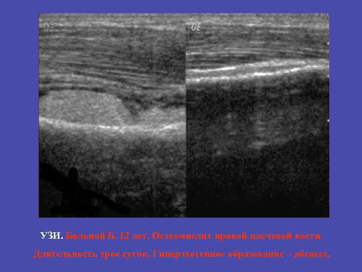 УЗИ. Больной Б. 12 лет. Остеомиелит правой плечевой кости. Длительность трое суток. Гиперэхогенное образование