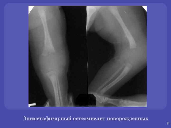 Эпифизарная дисплазия голеней рентген. Остеомиелит трубчатых костей рентген. Метафизарный остеомиелит. Гематогенный остеомиелит бедренной кости рентген. Гематогенный остеомиелит у детей рентген.