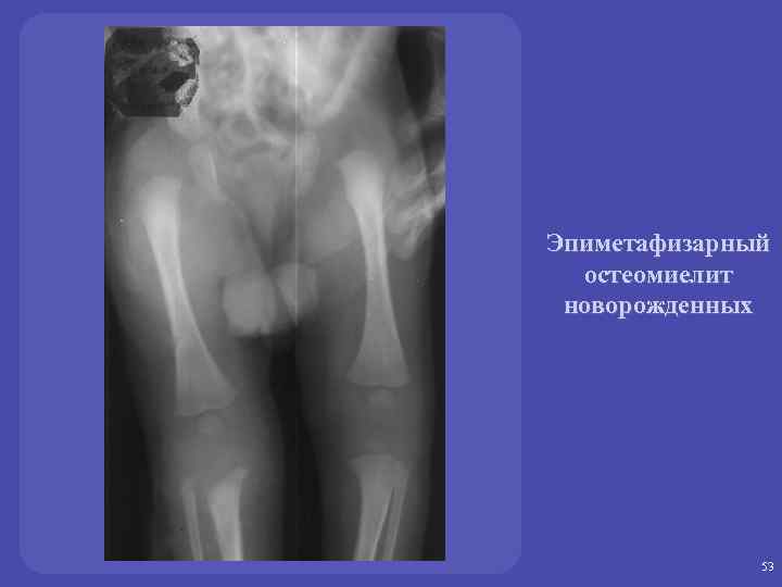 Эпиметафизарный остеомиелит новорожденных 53 
