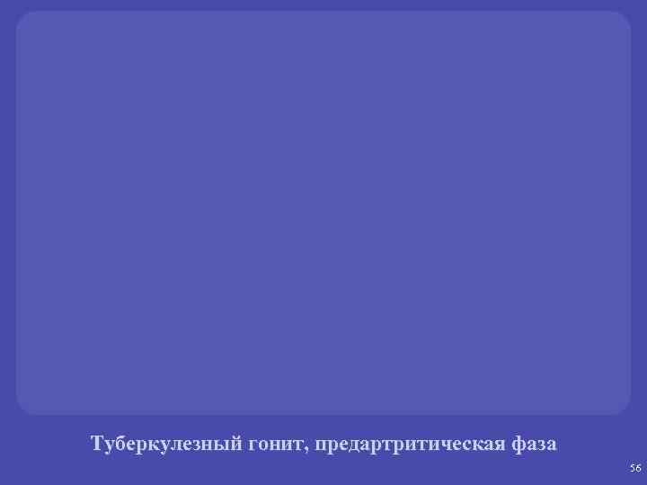 Туберкулезный гонит, предартритическая фаза 56 