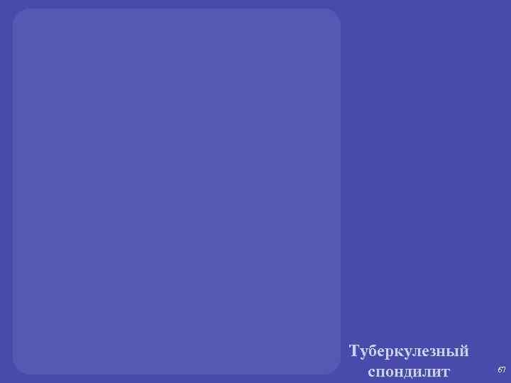 Туберкулезный спондилит 67 