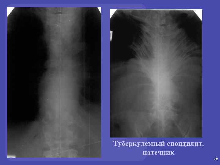 Туберкулезный спондилит, натечник 68 
