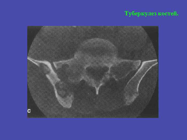 Туберкулез костей. 
