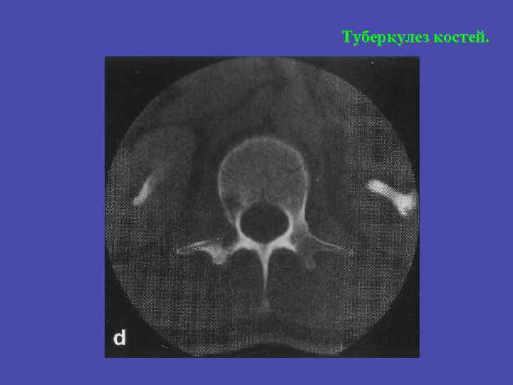 Туберкулез костей. 