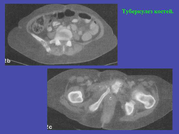Туберкулез костей. 