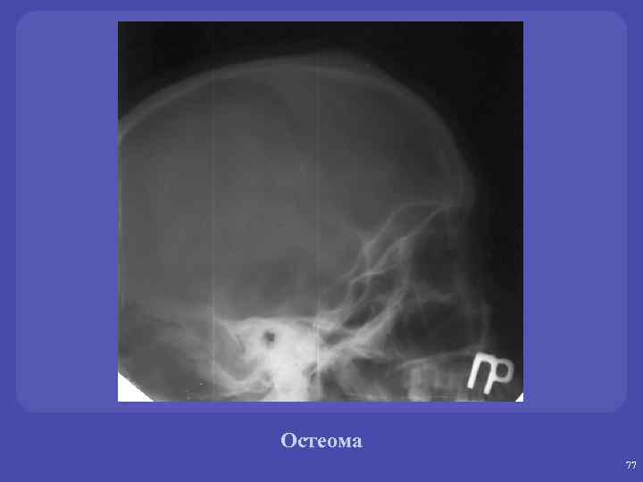 Остеома 77 