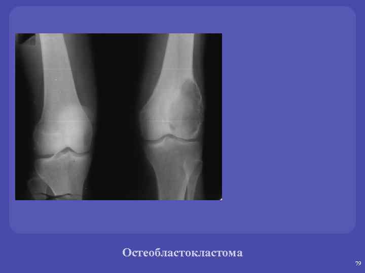 Остеобластокластома 79 