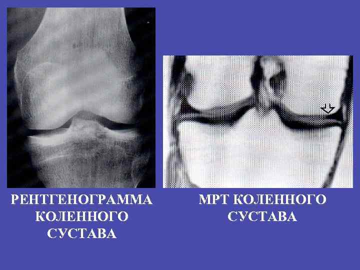 Мрт коленного сустава картинки