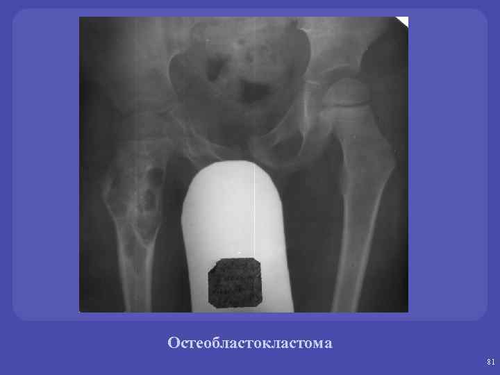 Остеобластокластома 81 