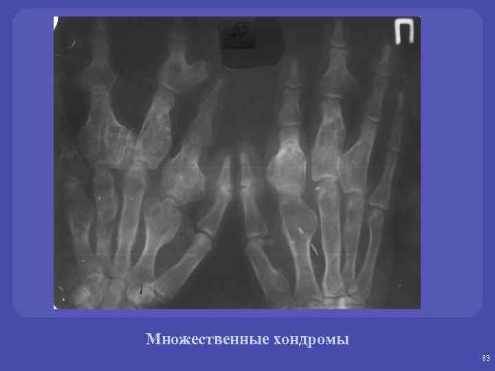 Множественные хондромы 83 