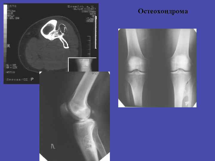 Остеохондрома бедренной. Остеохондрома кости рентген. Остеохондрома кости кт. Остеохондрома большеберцовой кости кт. Остеохондрома бедренной кости.