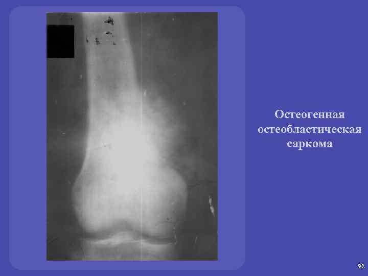 Остеогенная остеобластическая саркома 92 