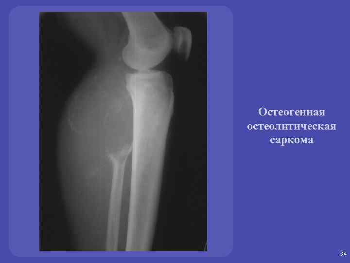 Остеогенная остеолитическая саркома 94 