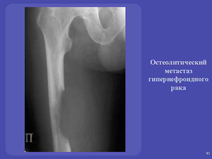 Очаг костей. Остеобластические метастазы рентген. Остеолитические метастазы рентген. Остеолитические метастазы в длинной трубчатой кости. Остеобластические метастазы в длинной трубчатой кости.