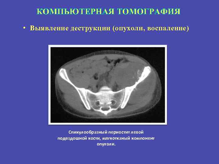 Кт картина краевой деструкции смежных костей наиболее характерна для