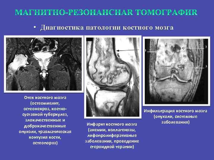  • Диагностика патологии костного мозга Отек костного мозга (остеомиелит, остеонекроз, костносуставной туберкулез, злокачественные