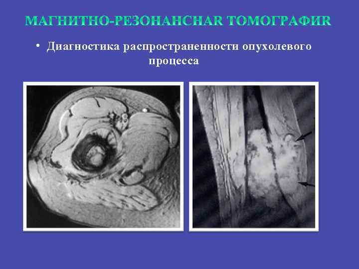  • Диагностика распространенности опухолевого процесса 