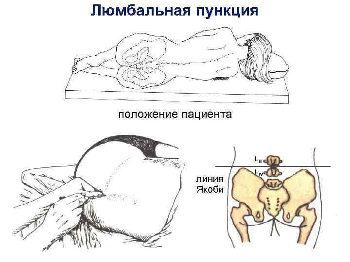 Люмбальная пункция положение пациента LIII линия Якоби LIV 