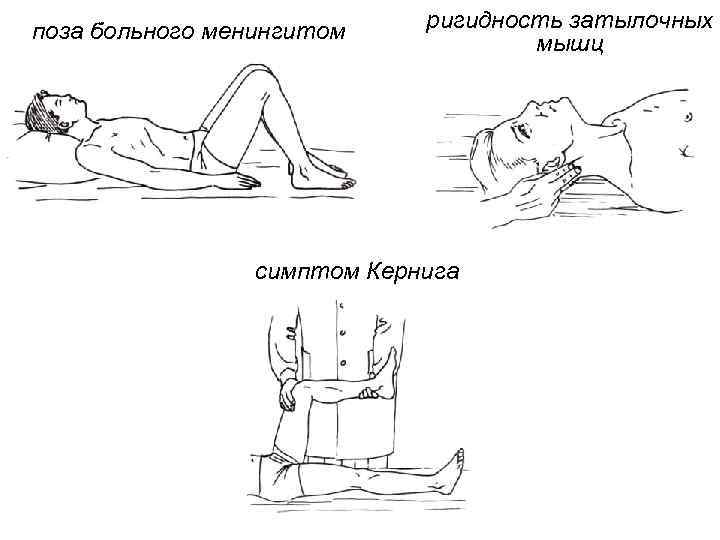 поза больного менингитом ригидность затылочных мышц симптом Кернига 