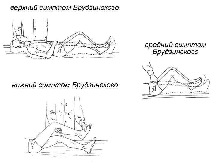 верхний симптом Брудзинского средний симптом Брудзинского нижний симптом Брудзинского 