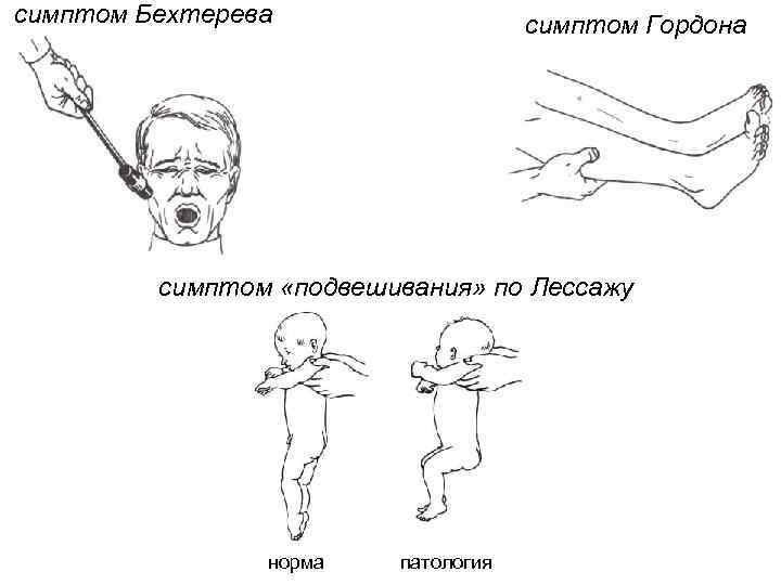 симптом Бехтерева симптом Гордона симптом «подвешивания» по Лессажу норма патология 