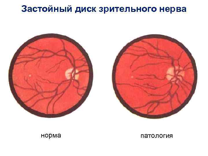 Застойный диск зрительного нерва норма патология 