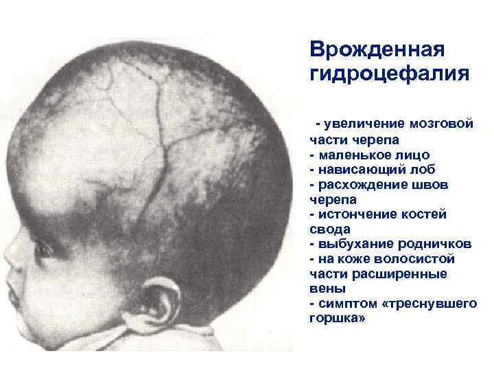 Врожденная гидроцефалия - увеличение мозговой части черепа - маленькое лицо - нависающий лоб -