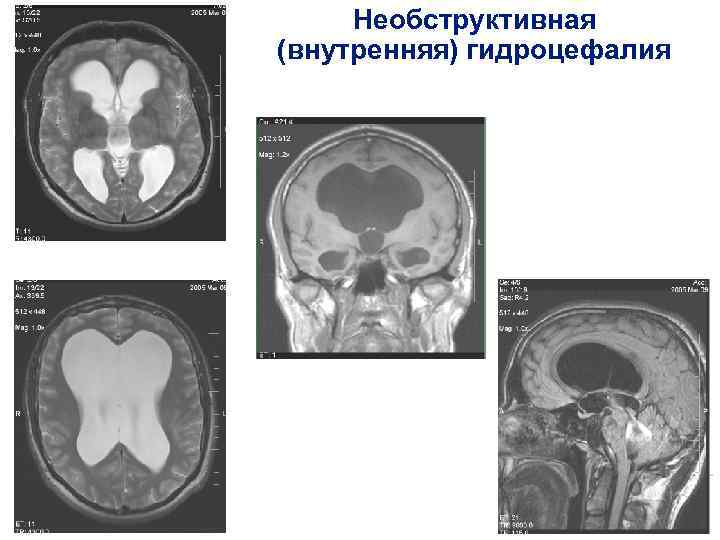 Необструктивная (внутренняя) гидроцефалия 