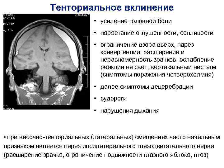 Вклинение головного мозга. Тенториальное отверстие головного мозга. Височно-тенториальное смещение. Ьенториальное вклинивание.