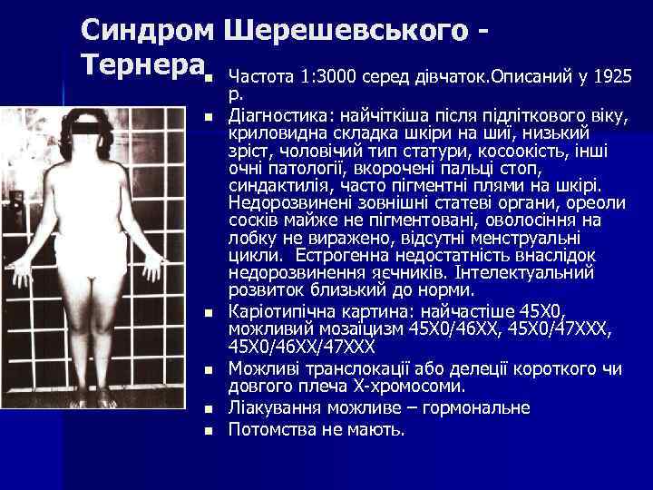 Синдром Шерешевського Тернераn Частота 1: 3000 серед дівчаток. Описаний у 1925 n n n