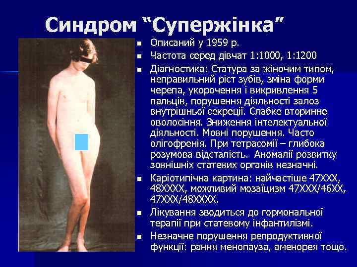 Синдром “Супержінка” n n n Описаний у 1959 р. Частота серед дівчат 1: 1000,